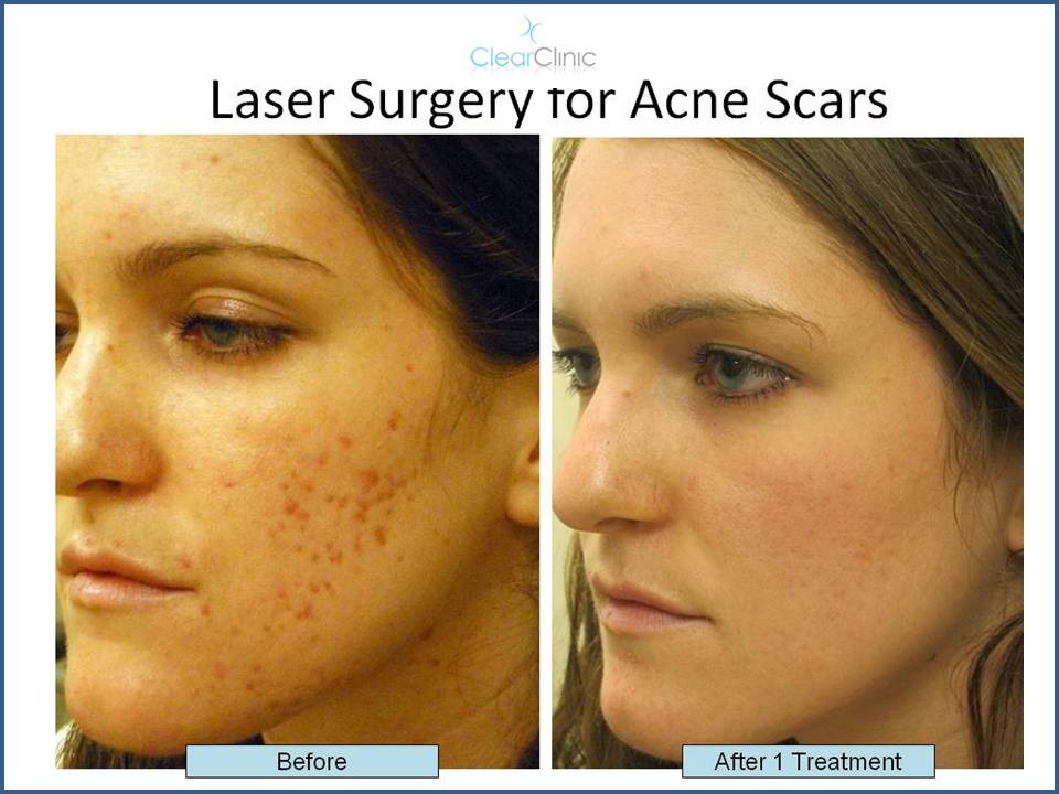 Why the KTP Laser Might be Right for You, How to Treat Redness on Skin